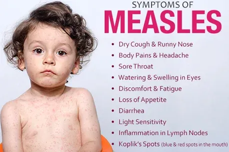 Measles | IASbaba