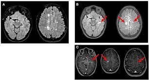 Frontiers | Severe Multiple Sclerosis Relapse After COVID-19 Vaccination: A Case Report