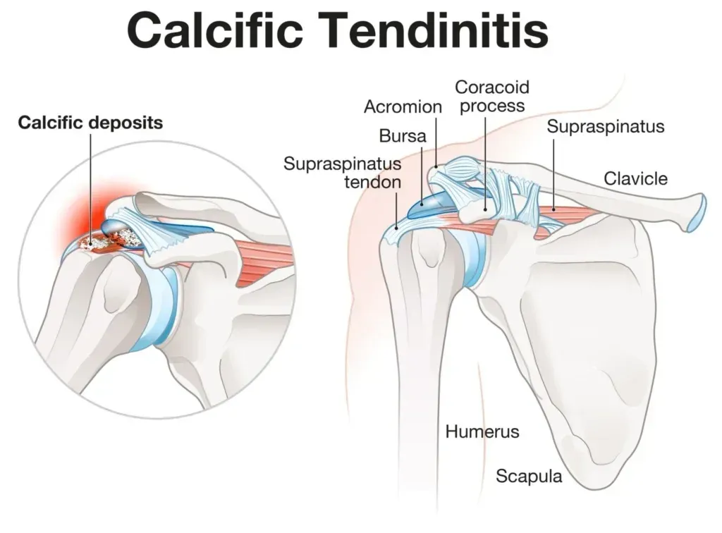 Calcific Tendinopathy: A Brief Overview