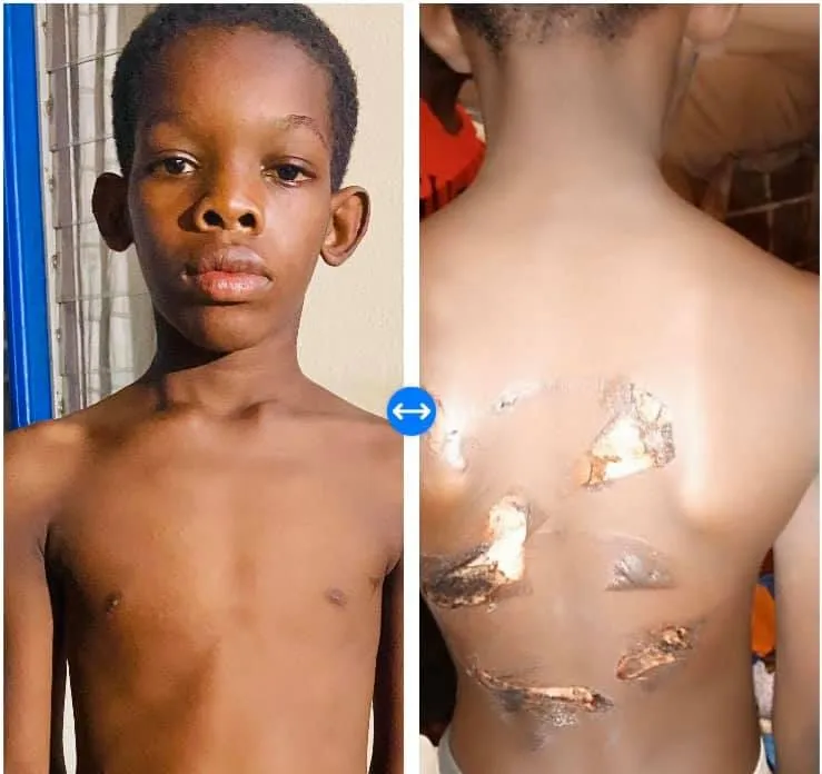 Le petit garçon brûlé à Yopougon par son oncle est sorti de l’hôpital