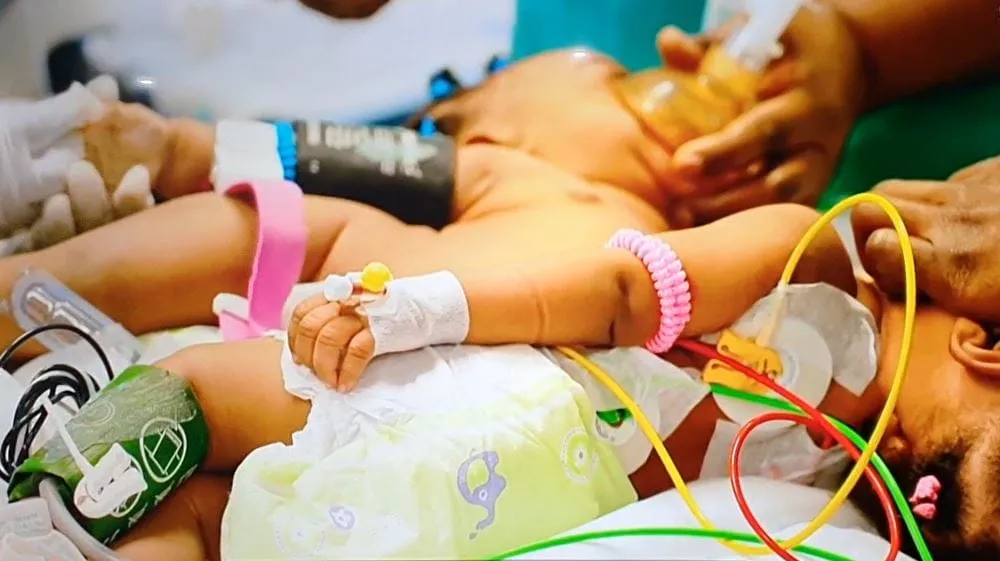 Côte d’Ivoire : Des sœurs siamoises séparées avec succès à l’Hôpital Mère-Enfant de Bingerville