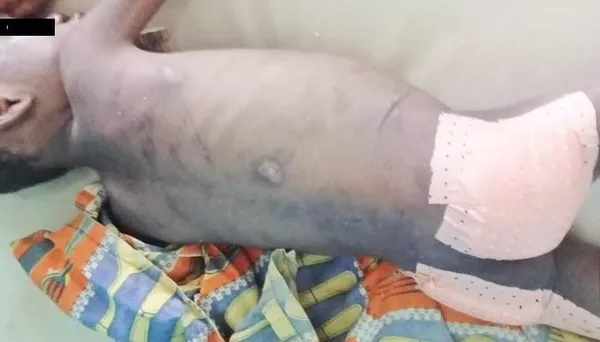 N’Douci : Un instituteur bénévole torture son neveu de 5 ans avec une machette incandescente et prend la fuite