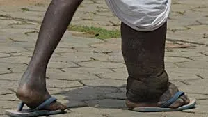 L’Afrique est confrontée à un double défi de freiner la propagation du Covid-19 et des maladies tropicales négligées (OMS) – Actualité ivoirienne 01/07/2020