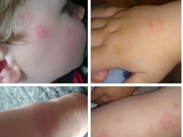 Lyme : un laboratoire américain d’armes biologiques soupçonné d’être à l’origine de la maladie