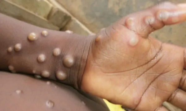 Côte d’Ivoire: aucun cas de variole du singe détecté à ce jour