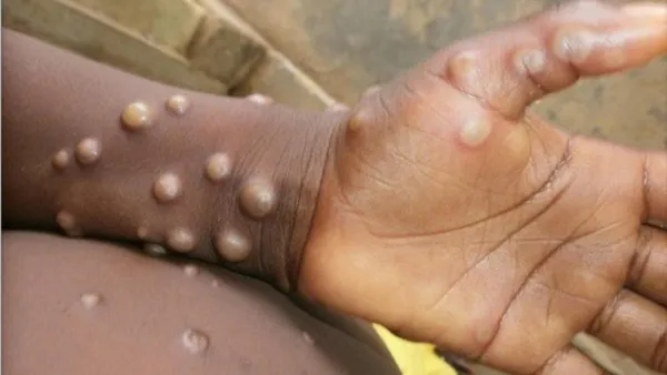 Variole du singe: quels symptômes et comment éviter le monkeypox?
