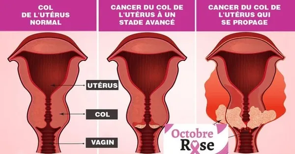 Campagne de sensibilisation et de dépistage des cancers du sein et du col de l’utérus à Tanda