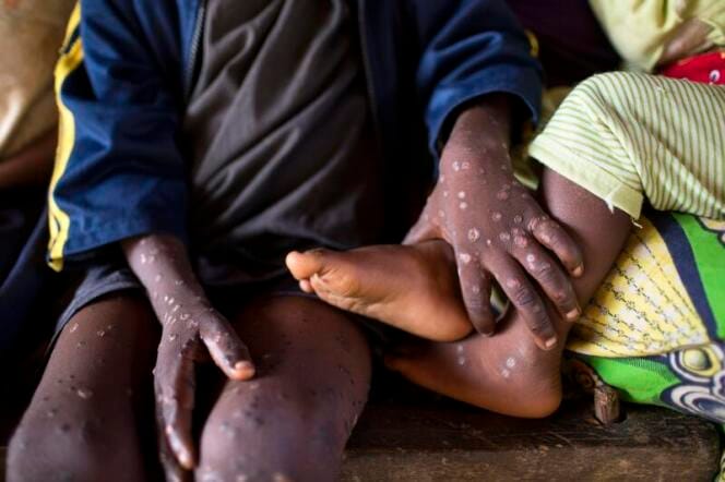 Maladie de la variole du singe (Monkeypox)